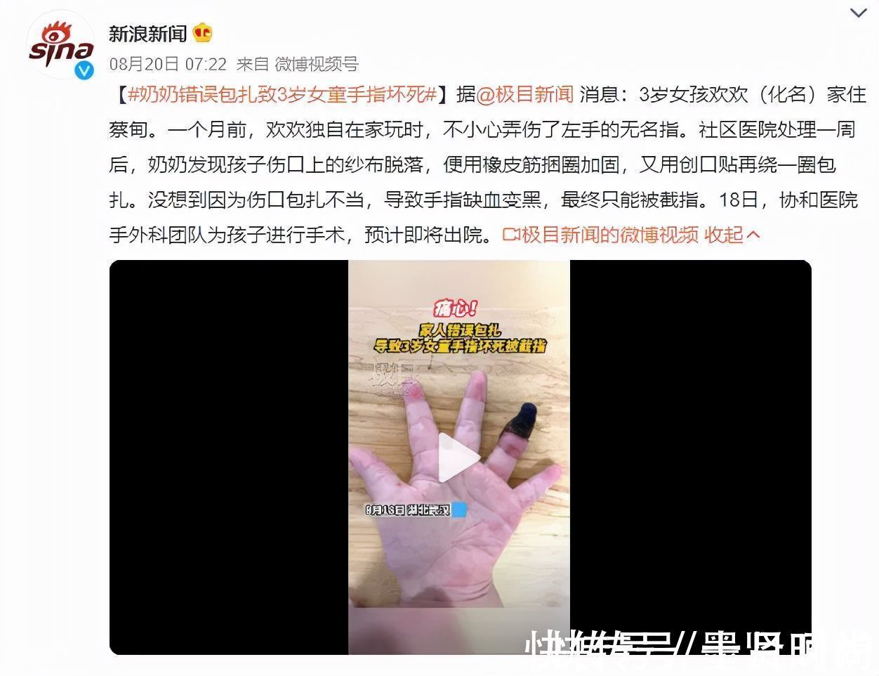 手指|三岁女童被活活截断手指,终生残疾!只因用错创可贴,快自查