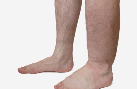 木耳|“溶栓高手”找到了,不是木耳,没事敞开喝,血栓悄悄地不见了