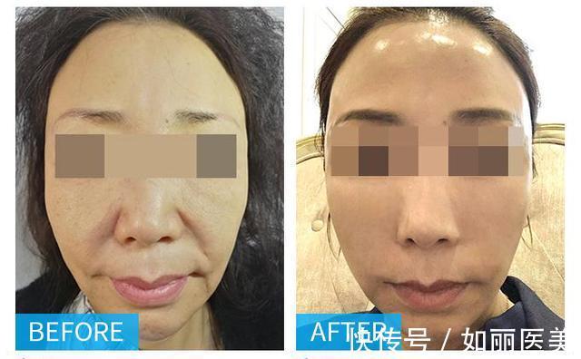 手术 关于拉皮手术的“传言”,50岁求美者公开了自己的真实感受