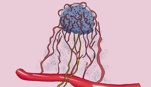 癌症|肺癌复发时间,大多在什么时间?复发时,身体有何征兆?