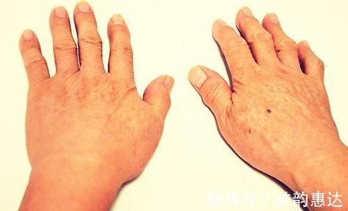 中老年人|体内有血栓的人,睡觉时,身体会有怪象出现,若你也有,趁早检查