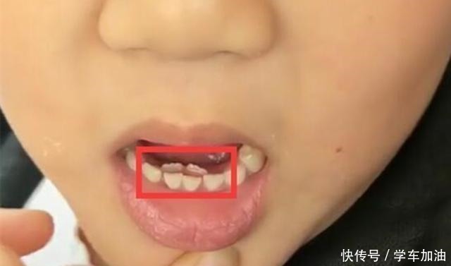 一起长大|7岁娃长出“双排牙”,奶奶的错误喂养方式要背锅,很多家长仍犯!