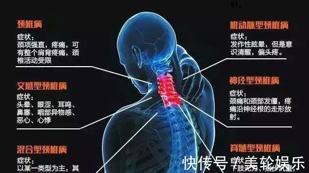 颈椎病|医生解惑什么样的颈椎病才需要手术治疗
