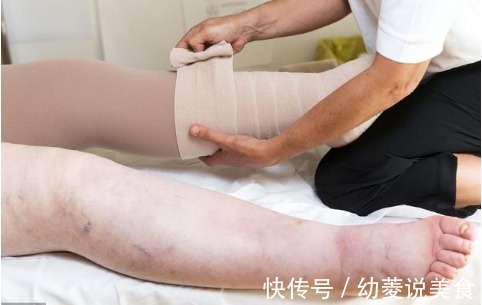 郭姐|老人脚肿腿肿,医生教他一招,不用吃药,4天后浮肿完全消失