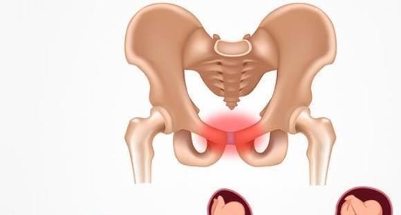 孕晚期最难熬的“耻骨痛”，5类孕妈要注意，千万别被找上门