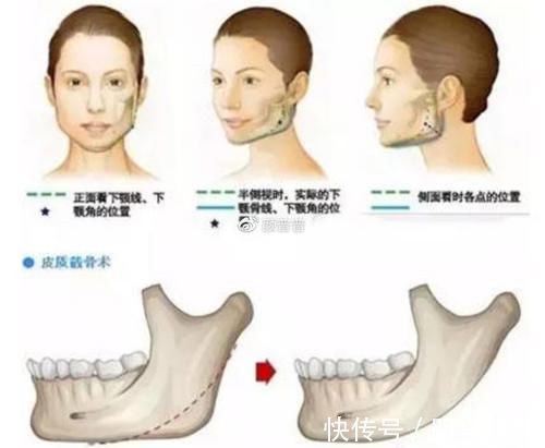 下颌角 关于下颌角手术，大家都会担心后遗症有哪些？有后遗症应该怎么办？