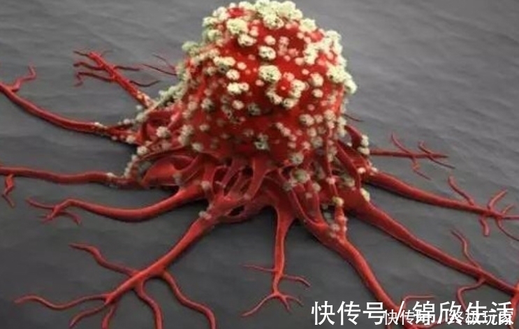 良性肿瘤|肿瘤手术后复发的几率是多少?做好4件事,或许有助降低复发率