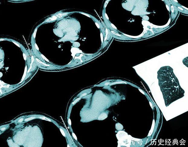 肺癌|肺气肿和肺癌在症状和临床上有什么区别,为健康,应该了解下