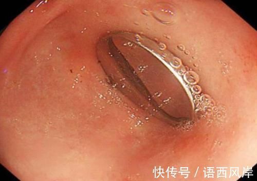 蜂蜜|宝宝误吞纽扣电池,奶奶不急着送医四处找蜂蜜,医生夸赞处置高明