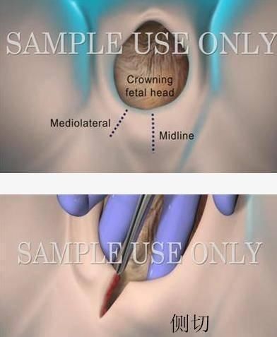 宝妈|顺产除了侧切,还有另一种切法,出血少疤痕浅,关键是痛感也小
