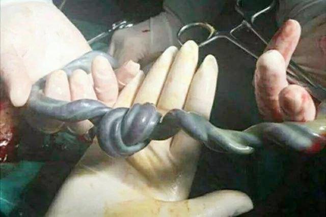 脐带|孕妈怀孕7个月脐带悄然断裂,很可能是“它”引起的,孕妈要注意