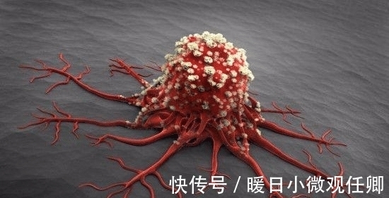 恐惧性|早晨上厕所时, 若发现这2种迹象, 可能“癌细胞”想近身, 别大意