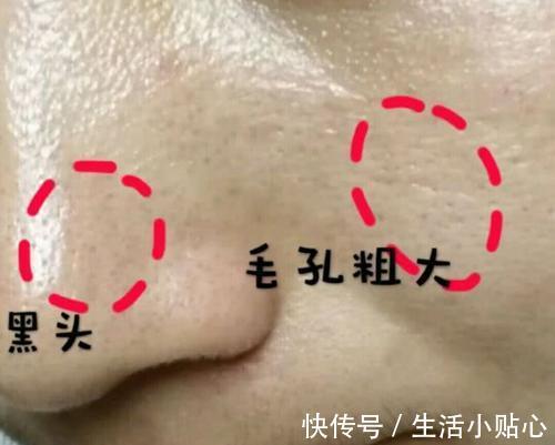 油脂|毛孔粗大应当重视毛孔清洁问题,毛孔干净了,颜值自然上去了