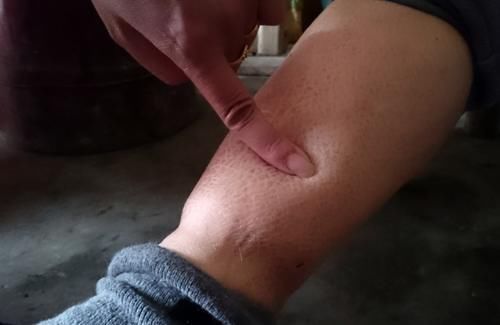 退烧药|只是吃了6粒药,男子患上肾衰竭这种药家家都有,但真不能瞎吃