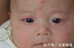 海鲜类|孩子皮肤过敏怎么办?家长们需要知道这些知识