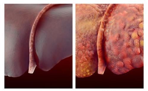 胆红素|发生肝硬化后,身体会有的4种表现,一定要了解
