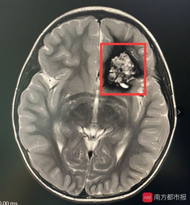 脑肿瘤|6岁儿童一口气读不了“白日依山尽”不是贵人语迟是脑肿瘤