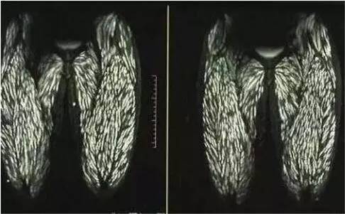 小龙虾|男孩从小吃小龙虾长大,肚子疼去医院检查后,医生习惯的后果