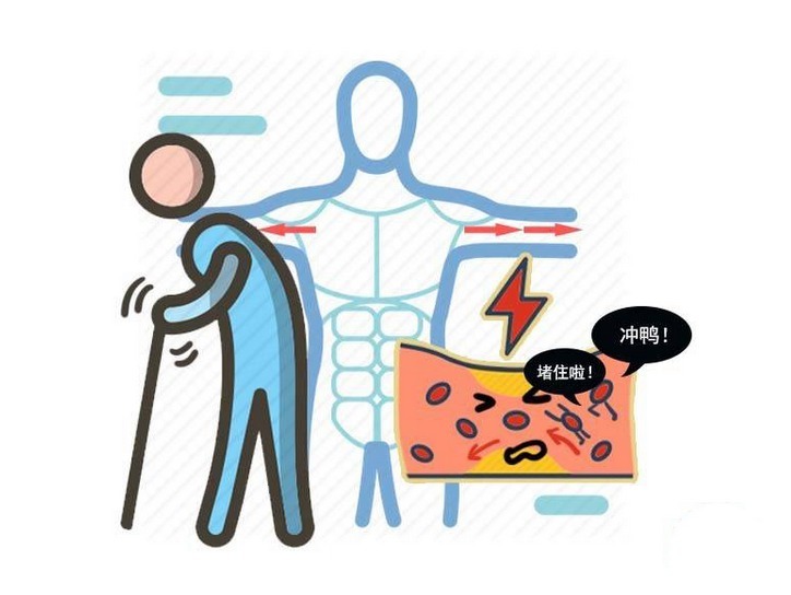 下肢|保健品防血栓是否可取!医生劝解:不如用好4味“药”,通畅血管