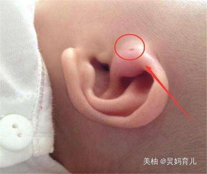 女儿|3岁女儿耳朵上长聪明孔,妈妈好奇用手一挤,随后怪自己手贱