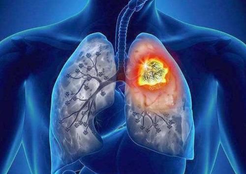 患上肺结节后，身体可能会有4个表现，不妨了解一下
