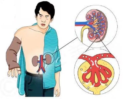 白蛋白尿|远离糖尿病肾病，从您点开这篇文章开始