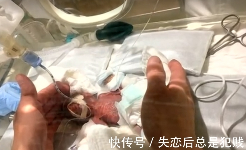 婴儿|世界最小男婴出生只有268克,网友:等于5个鸡蛋中