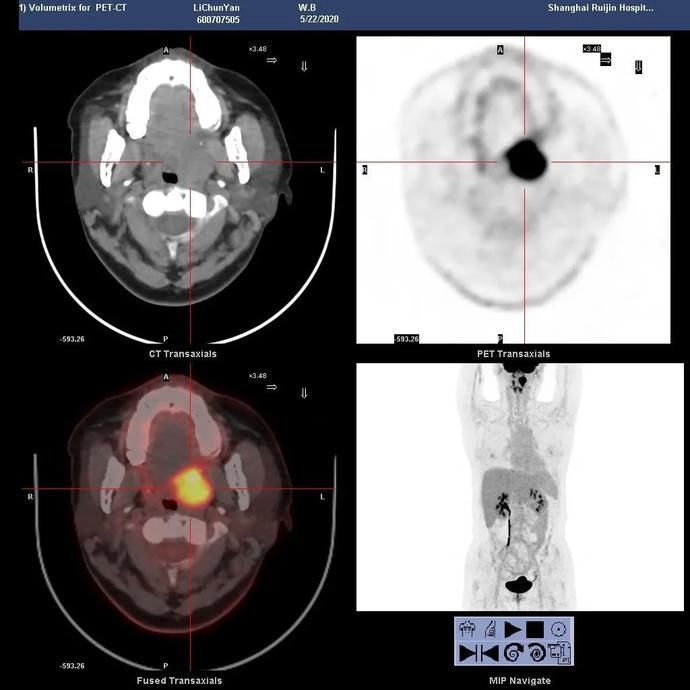 头颈部恶性肿瘤，怎样免除“切骨之痛”？|瑞金医术 | 切除