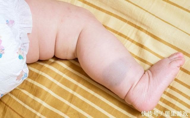 宝宝|宝宝为什么会长胎记?与孕期行为有关,孕妈怀孕后要克制自己