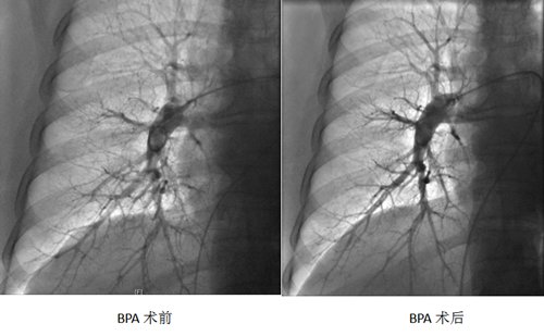 手术|壹点医典｜70岁老人患肺动脉高压，这个手术显著改善肺循环