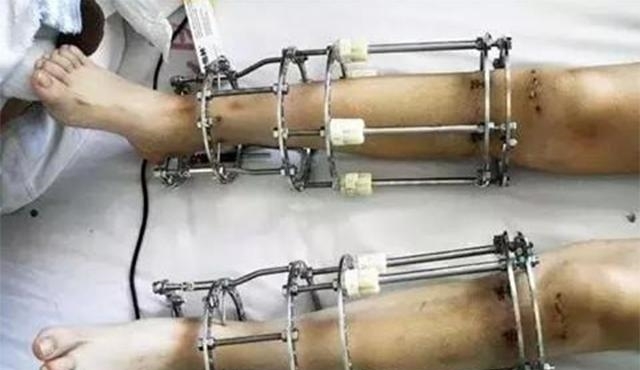 断骨|当年因矮身高自卑,花16万断骨增高7.2厘米的李亚诺,后来如何?