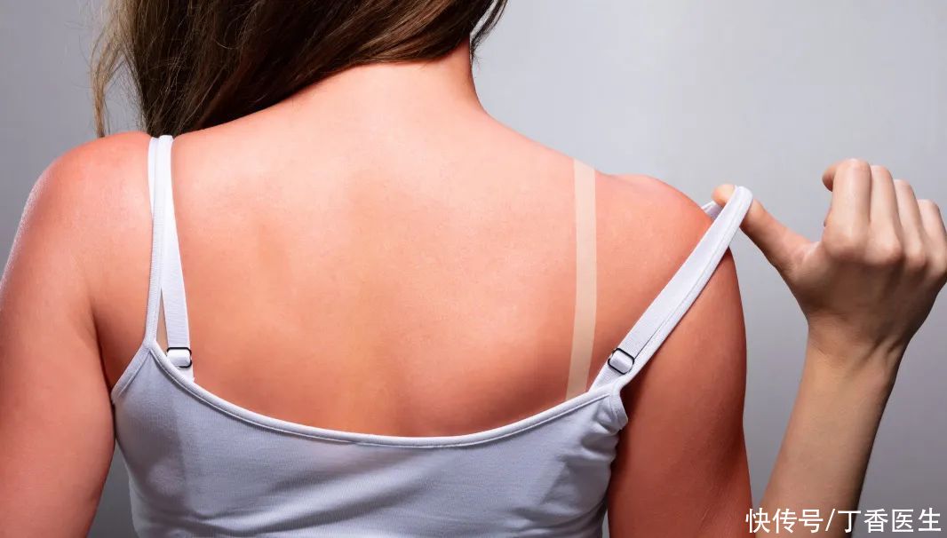 吊带|吊带印、短袖印太尴尬？两招让皮肤亮回来！