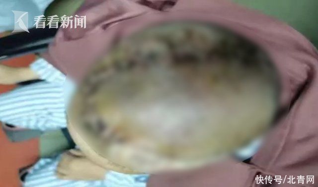 女子|偏信游医“土方法”女子头顶长出菠萝大肿瘤