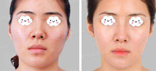 鼻部整形真的安全吗？假体隆鼻材料硅胶和膨体哪个更自然持久？