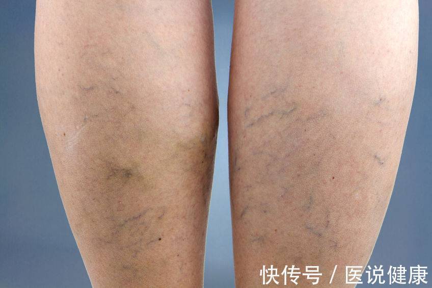 血流瘀滞|睡觉经常脚抽筋,除了缺钙因素外,可能和3种疾病有关,了解下