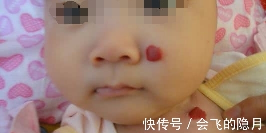 血管瘤|宝宝眉心有胎记,宝妈却不以为然,12个月宝宝送医抢救无效