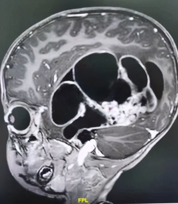 折翼天使们|2岁就查出肿瘤！这些让人心疼的折翼天使们，后来怎么样了？