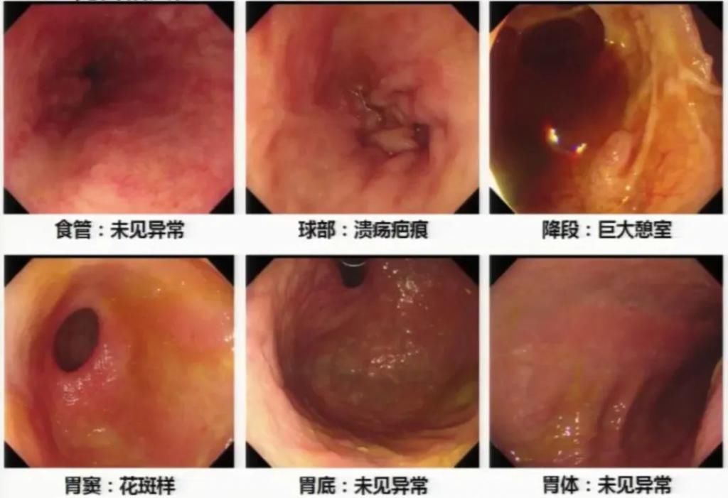 休克|反复便血十余天，一度出现失血性休克，原因竟然是……