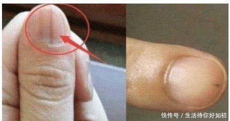 遗传|手指甲出现“竖纹”, 多半和这3个“情况”有关, 看完或许会明白!