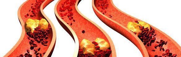 食物|加速高血压的3种食物，若你一个都不爱吃，那恭喜了