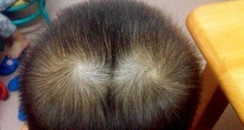 性格|为什么有的孩子头上有2个“旋”有关发旋的误解,你知道多少!