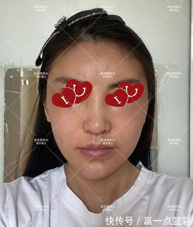 手术 40多岁大姐小拉皮手术全过程分享!