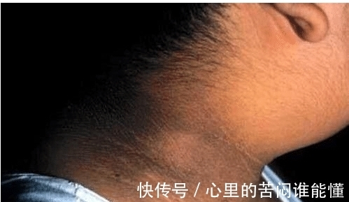 发黑|9岁小女孩脖颈发黑洗不掉,经医院检查后,医生的话却让家长笑了