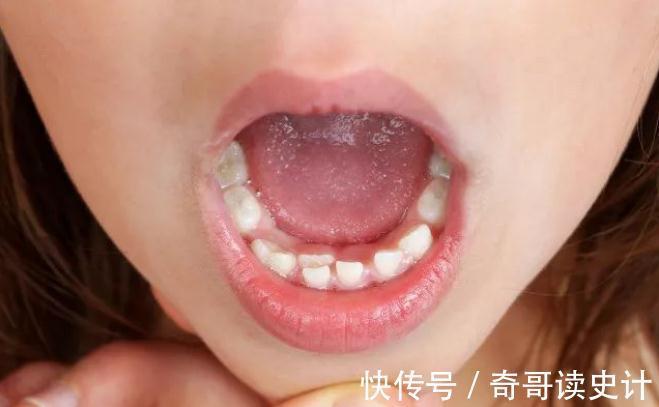 换牙期|孩子6岁乳牙不掉，长成“双排牙”，和遗传无关，原因在家长身上