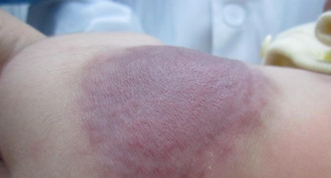 孕期|那个脸上有“蝙蝠”胎记的女孩,如今生活的怎么样?看完很欣慰