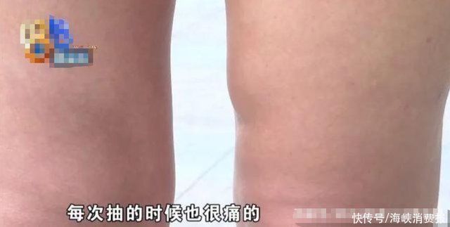 手术|女子做大腿吸脂手术，术后腿部有积液，跑了40多趟抽积液