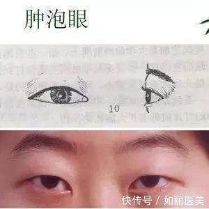 重睑 什么是割双眼皮呢？割双眼皮手术都包含哪些项目？你都了解吗