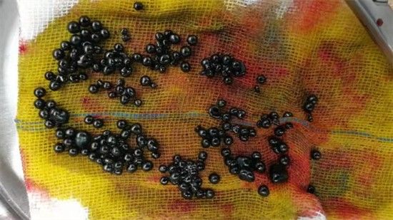 胆结石|吓人！浙江15岁男孩腹中取出100多个…他这个爱好很多人有