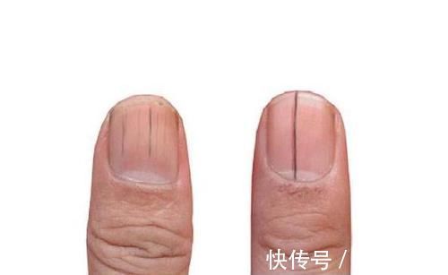 缺铁性贫血|指甲上出现了竖纹?可能跟这4个健康隐患有关,别不当回事!