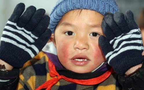 中医|“冻疮”是冬天极为常见的皮肤病,怎么去治疗冻疮呢中医有妙招